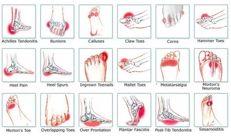 foot problems with pictures|foot pain identifier chart.